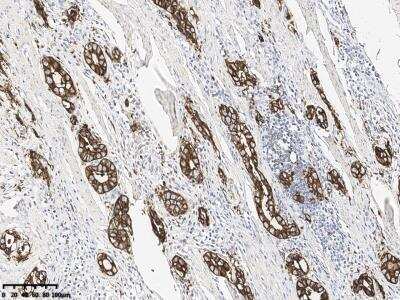 Immunohistochemistry-Paraffin: Claudin-18 Antibody (179) [NBP3-14643] - Staining of Claudin-18 in human gastric cancer with rabbit monoclonal antibody at 1:10000 dilution.