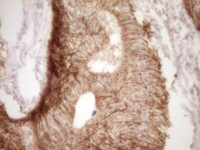 Immunohistochemistry: Claudin-3 Antibody (OTI1E7) - Azide and BSA Free [NBP2-70445] - Analysis of Adenocarcinoma of Human colon tissue. (Heat-induced epitope retrieval by 1 mM EDTA in 10mM Tris, pH8.5, 120C for 3min)