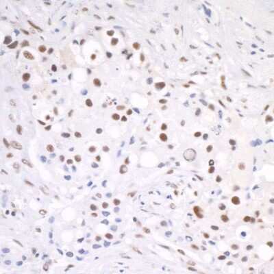 Immunohistochemistry: Cleavage stimulation factor 2 Antibody [NB100-57530] - Detection of human CSTF64 by immunohistochemistry. Sample: FFPE section of human lung carcinoma. Antibody: Affinity purified rabbit anti-CSTF64 (NB100-57530) used at a dilution of 1:200 (1ug/ml). Detection: DAB