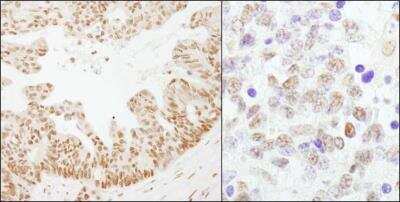 Immunohistochemistry-Paraffin: Cleavage stimulation factor 2 Antibody [NB100-57531] - Human ovarian carcinoma (left) and mouse teratoma (right). Antibody used at a dilution of 1:1000 (1ug/ml).