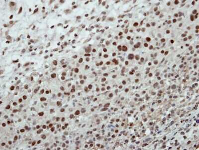 Immunohistochemistry-Paraffin: Cleavage stimulation factor 2 Antibody [NBP2-15915] - Immunohistochemical analysis of paraffin-embedded ES2 xenograft, using antibody at 1:500 dilution.