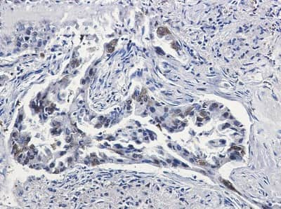 Immunohistochemistry-Paraffin: Coagulation Factor III/Tissue Factor Antibody (S04-7G2) [NBP3-14883] - Immunohistochemistry of Coagulation Factor III/Tissue Factor in paraffin-embedded Human lung cancer tissue using Coagulation Factor III/Tissue Factor Rabbit mAb at dilution 1/50