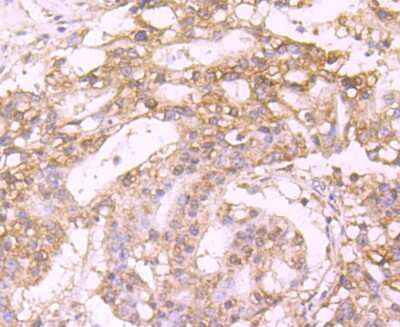 Immunohistochemistry-Paraffin: Coagulation Factor XIV/Protein C Antibody (JM93-61) [NBP2-66987] - Analysis of paraffin-embedded human stomach cancer tissue using anti-Protein C antibody. Counter stained with hematoxylin.