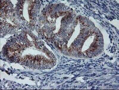 Immunohistochemistry: Coatomer Subunit Delta Antibody (OTI6A6) - Azide and BSA Free [NBP2-70203] - Staining of paraffin-embedded Adenocarcinoma of Human endometrium tissue using anti-Coatomer Subunit Delta mouse monoclonal antibody.