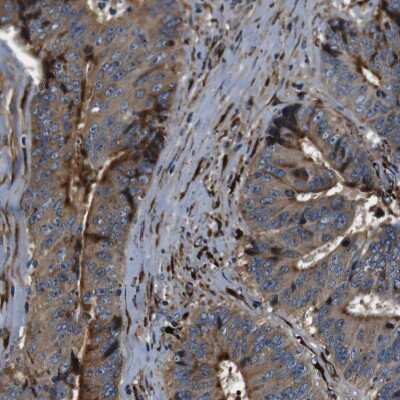 Immunohistochemistry-Paraffin: Collagen I alpha 1 Antibody [NBP1-82488] - Staining of human colorectal cancer shows strong strong cytoplasmic positivity in tumor cells.