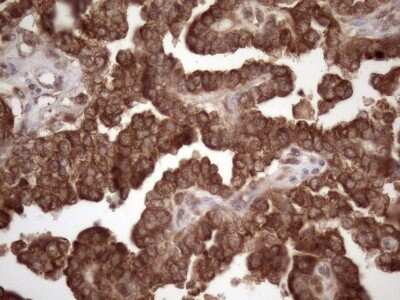 Immunohistochemistry: Common beta Chain Antibody (OTI4H3) - Azide and BSA Free [NBP2-70463] - Analysis of Adenocarcinoma of Human ovary. (Heat-induced epitope retrieval by 1mM EDTA in 10mM Tris buffer (pH8.5) at 120C for 3 min)