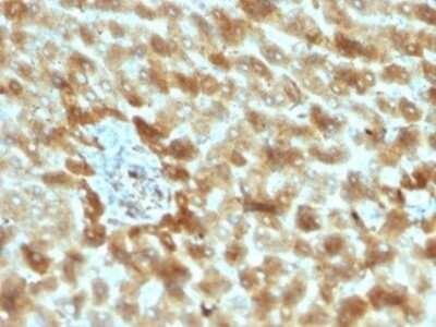 Immunohistochemistry-Paraffin: Complement C3d Antibody (C3D/2891) - Azide and BSA Free [NBP3-08764] - Formalin-fixed, paraffin-embedded human hepatocellular carcinoma stained with Complement C3d Antibody (C3D/2891) at 2ug/ml. HIER: Tris/EDTA, pH9.0, 45min. HRP-polymer, 30min. DAB, 5min.