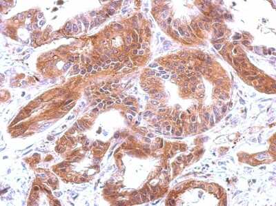 Immunohistochemistry-Paraffin: Complement C4a Antibody [NBP2-14893] -  Human hepatoma, using C4 antibody [N1N2-2], N-term antibody at 1:200 dilution. Antigen Retrieval: Trilogy™ (EDTA based, pH 8.0) buffer, 15min