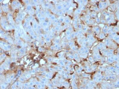 Immunohistochemistry-Paraffin: Complement Component C1qA Antibody (C1QA/2955) [NBP3-08748] - Formalin-fixed, paraffin-embedded human Renal Cell Carcinoma stained with Complement Component C1qA Mouse Monoclonal Antibody (Complement Component C1qA/2955).