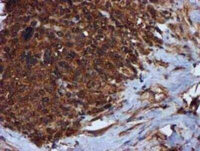 Immunohistochemistry-Paraffin: Complement Component C1s Antibody (4E3) [NBP2-01625] -  Staining of paraffin-embedded Adenocarcinoma of Human breast tissue using anti-Complement Component C1s mouse monoclonal antibody.