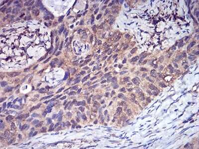 Immunohistochemistry: Complement Factor H-related 5/CFHR5 Antibody (3A10A5) [NBP2-52441] - Analysis of paraffin-embedded cervical cancer tissues using CFHR5 mouse mAb with DAB staining.