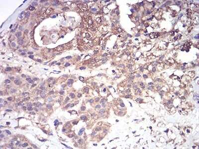 Immunohistochemistry: Complement Factor H-related 5/CFHR5 Antibody (3A10A5) [NBP2-52441] - Analysis of paraffin-embedded ovarian cancer tissues using CFHR5 mouse mAb with DAB staining.