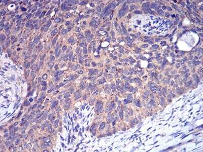 Immunohistochemistry: Complement Factor H-related 5/CFHR5 Antibody (3E1E10) [NBP2-52440] - Analysis of paraffin-embedded cervical cancer tissues using CFHR5 mouse mAb with DAB staining.