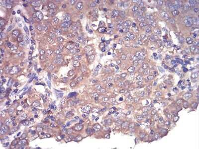 Immunohistochemistry: Complement Factor H-related 5/CFHR5 Antibody (3E1E10) [NBP2-52440] - Analysis of paraffin-embedded endometrial cancer tissues using CFHR5 mouse mAb with DAB staining.