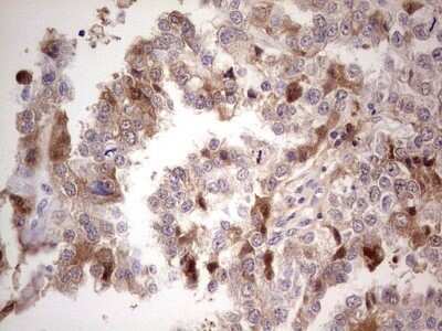 Immunohistochemistry: Complement Factor I Antibody (OTI7C9) - Azide and BSA Free [NBP2-70997] - Analysis of Adenocarcinoma of Human ovary tissue, dilution 1:150