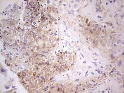 Immunohistochemistry: Complement Factor I Antibody (OTI7C9) - Azide and BSA Free [NBP2-70997] - Analysis of Carcinoma of Human lung tissue, dilution 1:150