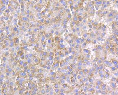 Immunohistochemistry: Connexin 45/GJC1 Antibody [NBP2-76925] - Immunohistochemical analysis of paraffin-embedded human liver cancer tissue using anti-Connexin 45 / GJA7 / Cx45 antibody. The section was pre-treated using heat mediated antigen retrieval with Tris-EDTA buffer (pH 8.0-8.4) for 20 minutes.The tissues were blocked in 5% BSA for 30 minutes at room temperature, washed with ddH2O and PBS, and then probed with the antibody at 1/50 dilution, for 30 minutes at room temperature and detected using an HRP conjugated compact polymer system. DAB was used as the chromogen. Counter stained with hematoxylin and mounted with DPX.