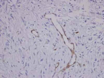 Immunohistochemistry-Paraffin: Coronin 3 Antibody [NBP1-31283] - human Sarcoma meta to brain Blood Vessel, using CORO1C antibody at 1:100 dilution. Antigen Retrieval: Trilogy™ (EDTA based, pH 8.0) buffer, 15min.