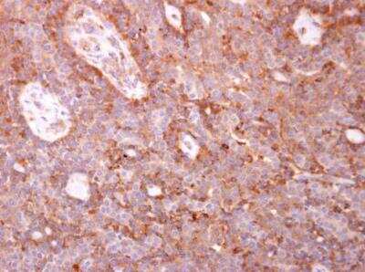 Immunohistochemistry-Paraffin: Coronin 3 Antibody [NBP2-15968] - Human lung carcinoma. Coronin 1C antibody [C1C3] diluted at 1:500. Antigen Retrieval: Trilogy™ (EDTA based, pH 8.0) buffer, 15min