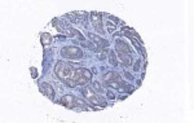 Immunohistochemistry-Paraffin: Coronin 3 Antibody [NBP2-27289] - Staining with anti-CORO1C antibody in breast cancer tissue at 1:100 dilution.