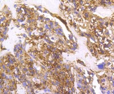 Immunohistochemistry-Paraffin: Cortactin Antibody (SC61-08) [NBP2-67632] - Analysis of paraffin-embedded human breast carcinoma tissue using anti-Cortactin antibody. Counter stained with hematoxylin.