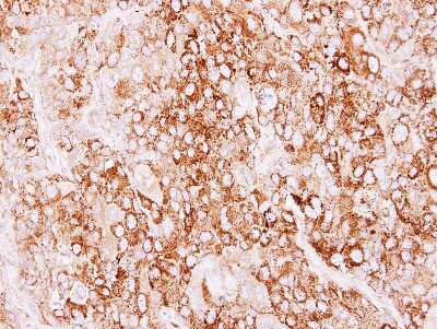 Immunohistochemistry-Paraffin: Creatine kinase MT 1A Antibody [NBP2-16005] - Immunohistochemical analysis of paraffin-embedded BT474 xenograft, using antibody at 1:500 dilution.