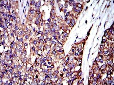 Immunohistochemistry: Crk Antibody (3G11C1) [NBP2-37569] - Immunohistochemical analysis of paraffin-embedded bladder cancer tissues using CRK mouse mAb with DAB staining.