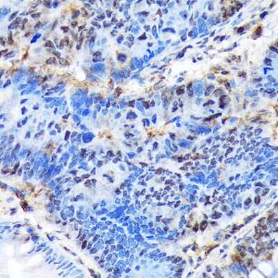 Immunohistochemistry-Paraffin: Ctip1 Antibody (3M8M3) [NBP3-16790] - Immunohistochemistry of paraffin-embedded human colon carcinoma using Ctip1 Rabbit mAb (NBP3-16790) at dilution of 1:100 (40x lens).Perform microwave antigen retrieval with 10 mM Tris/EDTA buffer pH 9.0 before commencing with IHC staining protocol.