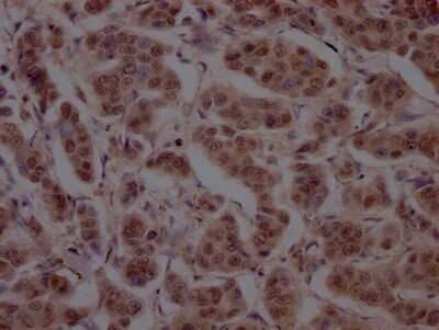 Immunohistochemistry: Cullin 3 Antibody (7B6) [NBP3-15168] - IHC image of Cullin 3 antibody diluted at 1:100 and staining in paraffin-embedded human breast cancer. After dewaxing and hydration, antigen retrieval was mediated by high pressure in a citrate buffer (pH 6.0). Section was blocked with 10% normal goat serum 30 minutes at RT. Then primary antibody (1% BSA) was incubated at 4C overnight. The primary is detected by a Goat anti-rabbit IgG polymer labeled by HRP and visualized using 0.05% DAB.