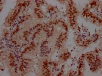 Immunohistochemistry: Cullin 3 Antibody (7B6) [NBP3-15168] - IHC image of Cullin 3 antibody diluted at 1:100 and staining in paraffin-embedded human prostate cancer. After dewaxing and hydration, antigen retrieval was mediated by high pressure in a citrate buffer (pH 6.0). Section was blocked with 10% normal goat serum 30 minutes at RT. Then primary antibody (1% BSA) was incubated at 4C overnight. The primary is detected by a Goat anti-rabbit IgG polymer labeled by HRP and visualized using 0.05% DAB.