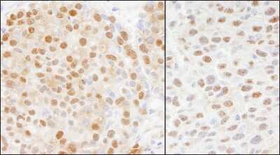 <b>Independent Antibodies Validation and Biological Strategies Validation.</b>Immunohistochemistry-Paraffin: Cullin 4a Antibody [NB100-2267] - Section of human breast carcinoma (left) and mouse squamous cell carcinoma (right). Antibody: Affinity purified rabbit anti-Cul4a used at a dilution of 1:1,000 (1ug/ml). Detection: DAB