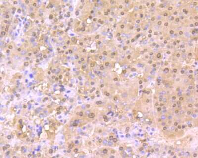 Immunohistochemistry-Paraffin: Cullin 4a Antibody (JU07-33) [NBP2-75459] - Analysis of paraffin-embedded human liver cancer tissue using anti-Cullin 4a antibody. Counter stained with hematoxylin.