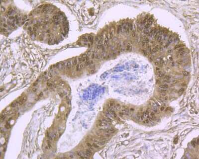 Immunohistochemistry-Paraffin: Cullin 4a Antibody (JU07-33) [NBP2-75459] - Analysis of paraffin-embedded human colon cancer tissue using anti-Cullin 4a antibody. Counter stained with hematoxylin.