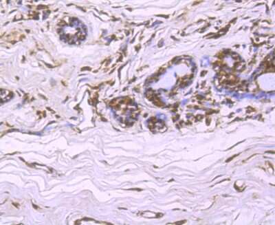 Immunohistochemistry-Paraffin: Cullin 4a Antibody (JU07-33) [NBP2-75459] - Analysis of paraffin-embedded human breast cancer tissue using anti-Cullin 4a antibody. Counter stained with hematoxylin.