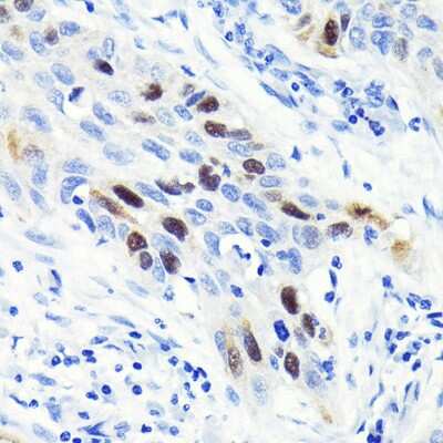 Immunohistochemistry-Paraffin: Cyclin A2 Antibody (3E9Z3) [NBP3-15625] - Immunohistochemistry of paraffin-embedded human lung cancer using Cyclin A2 Rabbit mAb (NBP3-15625) at dilution of 1:100 (40x lens).Perform microwave antigen retrieval with 10 mM PBS buffer pH 7.2 before commencing with IHC staining protocol.