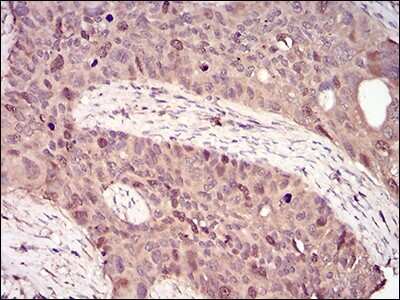 Immunohistochemistry: Cyclin A2 Antibody (6B4D11) [NBP2-52436] - Analysis of paraffin-embedded cervical cancer tissues using CCNA2 mouse mAb with DAB staining.