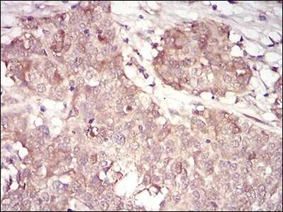 Immunohistochemistry: Cyclin A2 Antibody (6B4D11) [NBP2-52436] - Analysis of paraffin-embedded bladder cancer tissues using CCNA2 mouse mAb with DAB staining.