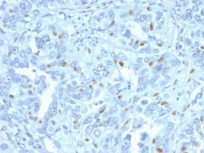 Immunohistochemistry-Paraffin: Cyclin A2 Antibody (CCNA2/2333) - Azide and BSA Free [NBP3-08789] - Formalin-fixed, paraffin-embedded human Endometrial Carcinoma stained with Cyclin A2 Mouse Monoclonal Antibody (CCNA2/2333).