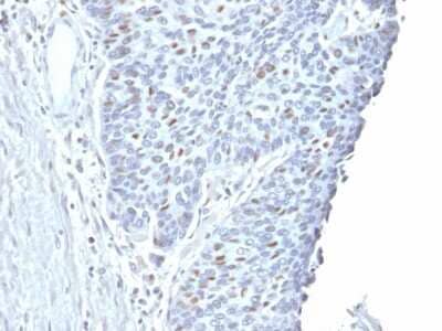 Immunohistochemistry-Paraffin: Cyclin A2 Antibody (CCNA2/2333) - Azide and BSA Free [NBP3-08789] - Formalin-fixed, paraffin-embedded human Endometrial Carcinoma stained with Cyclin A2 Mouse Monoclonal Antibody (CCNA2/2333).