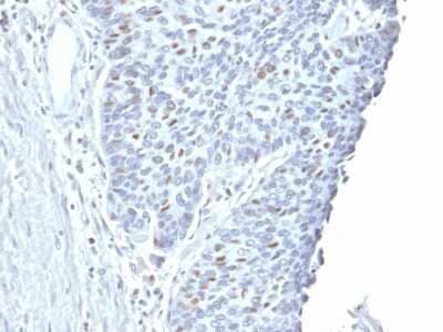 Immunohistochemistry-Paraffin: Cyclin A2 Antibody (CCNA2/2333) [NBP3-07468] - Formalin-fixed, paraffin-embedded human Endometrial Carcinoma stained with Cyclin A2 Mouse Monoclonal Antibody (CCNA2/2333).