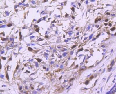Immunohistochemistry-Paraffin: Cyclin A2 Antibody (SD2052) [NBP2-67754] - Analysis of paraffin-embedded human breast carcinoma tissue using anti-Cyclin A2 antibody. Counter stained with hematoxylin.