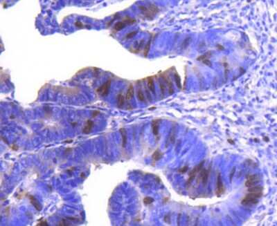 Immunohistochemistry-Paraffin: Cyclin A2 Antibody (SD2052) [NBP2-67754] - Analysis of paraffin-embedded human colon cancer tissue using anti-Cyclin A2 antibody. Counter stained with hematoxylin.