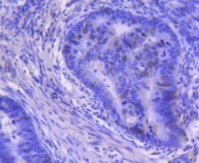 Immunohistochemistry-Paraffin: Cyclin A2 Antibody (SD2053) [NBP2-67813] - Analysis of paraffin-embedded human colon cancer tissue using anti-Cyclin A1/A2 antibody. Counter stained with hematoxylin.