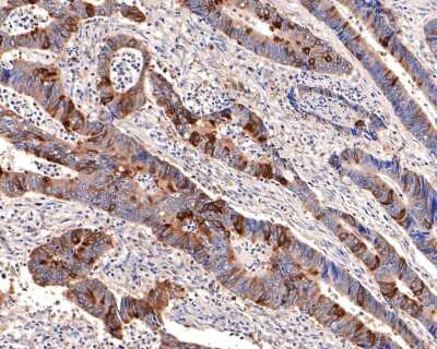 Immunohistochemistry-Paraffin: Cyclin B1 Antibody (SU33-03) [NBP2-67464] - Analysis of paraffin-embedded human colon carcinoma tissue with Rabbit anti-Cyclin B1 antibody washed with ddH2O and PBS, and then probed with the primary antibody  at 1/400 dilution for 1 hour at room temperature. The detection was performed using an HRP conjugated compact polymer system. DAB was used as the chromogen. Tissues were counterstained with hematoxylin and mounted with DPX.