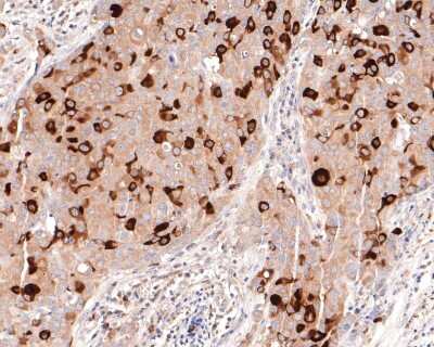 Immunohistochemistry-Paraffin: Cyclin B1 Antibody (SU33-03) [NBP2-67464] - Analysis of paraffin-embedded human breast carcinoma tissue with Rabbit anti-Cyclin B1 antibody washed with ddH2O and PBS, and then probed with the primary antibody  at 1/400 dilution for 1 hour at room temperature. The detection was performed using an HRP conjugated compact polymer system. DAB was used as the chromogen. Tissues were counterstained with hematoxylin and mounted with DPX.