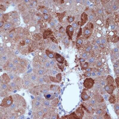 Immunohistochemistry-Paraffin: Cyclin B2 Antibody (1L9B9) [NBP3-16663] - Immunohistochemistry of paraffin-embedded human liver cancer using Cyclin B2 Rabbit mAb (NBP3-16663) at dilution of 1:100 (40x lens).Perform microwave antigen retrieval with 10 mM Tris/EDTA buffer pH 9.0 before commencing with IHC staining protocol.