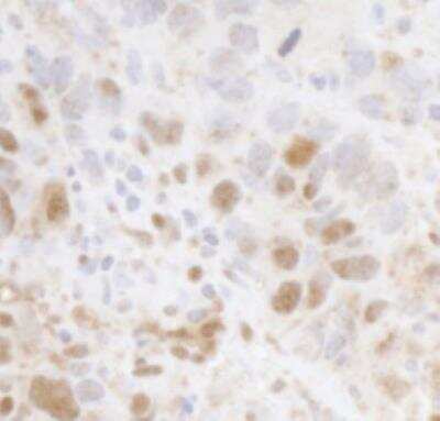 Immunohistochemistry-Paraffin: Cyclin C Antibody [NBP1-18878] - Section of human breast carcinoma. Antibody: Affinity purified rabbit anti-Cyclin C used at a dilution of 1:1,000 (1ug/ml). Detection: DAB