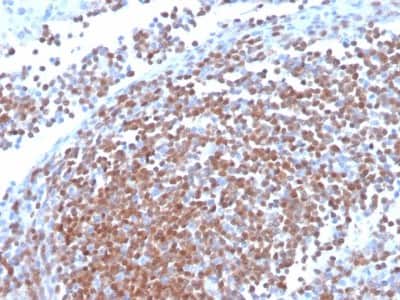 Immunohistochemistry-Paraffin: Cyclin D1 Antibody (CCND1/3370R) - Azide and BSA Free [NBP3-08955] - Formalin-fixed, paraffin-embedded human mantle cell lymphoma stained Cyclin D1 Recombinant Rabbit Monoclonal Antibody (CCND1/3370R).