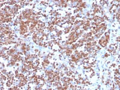 Immunohistochemistry-Paraffin: Cyclin D1 Antibody (CCND1/3370R) - Azide and BSA Free [NBP3-08955] - Formalin-fixed, paraffin-embedded human mantle cell lymphoma stained Cyclin D1 Recombinant Rabbit Monoclonal Antibody (CCND1/3370R).