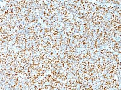 Immunohistochemistry-Paraffin: Cyclin D1 Antibody (DCS-6) - IHC-Prediluted [NBP2-44584] - Formalin-fixed, paraffin-embedded human Mantle Cell Lymphoma stained with Cyclin D1 Antibody (DCS-6).